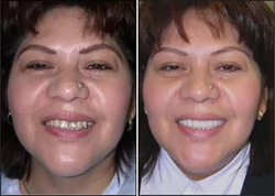 Before And After Tooth Colored Filling Patient