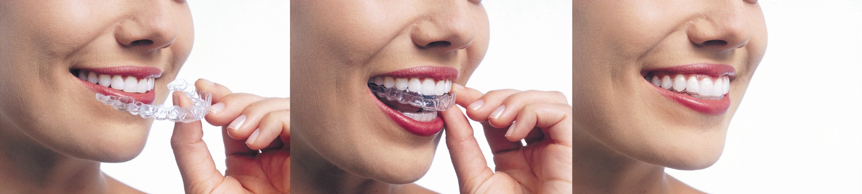 Invisalign Clear Braces In White Plains