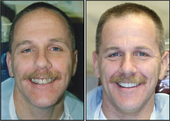 Before and After Teeth Veneers Westchester County Patient