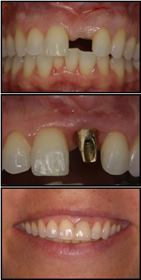 Scarsdale Dentist Providing Beautiful Dental Implant Treatments