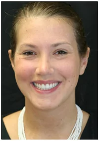 Scarsdale Dental Veneers Patient