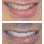 Teeth Whitening in White Plains,NY