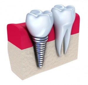 Improvements In Hartsdale Implant Dentistry