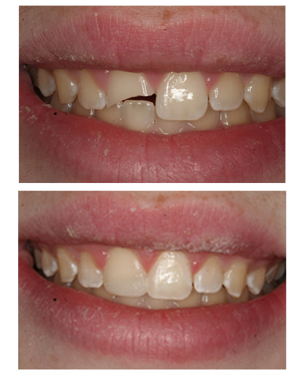 Cosmeitc bonding restoration at The Dental Design Center in White Plains