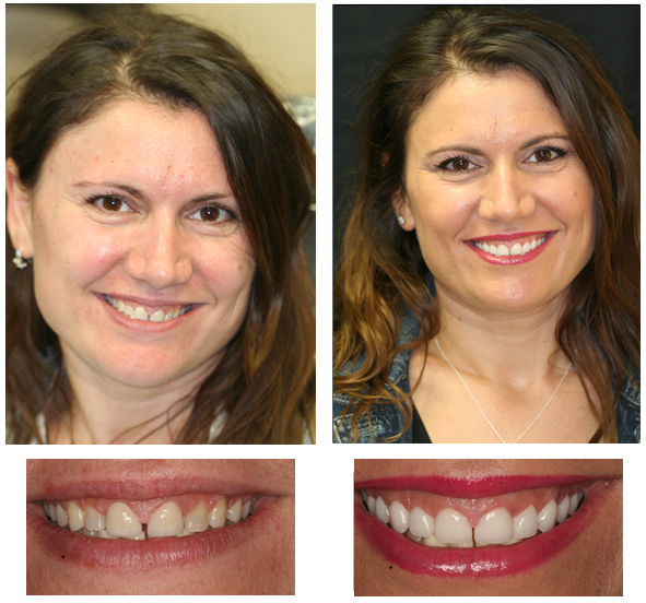 Porcelain Veneers and Crowns before and after photos