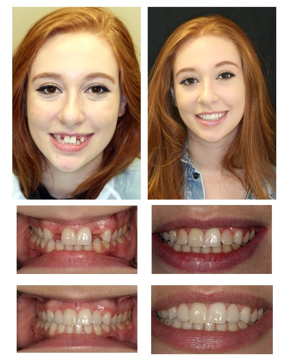 Porcelain bridges replace missing teeth