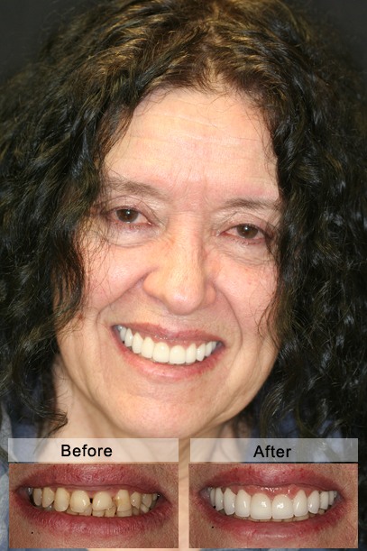 Full cosmetic and functional restoration of entire top jaw with porcelain crowns and veneers