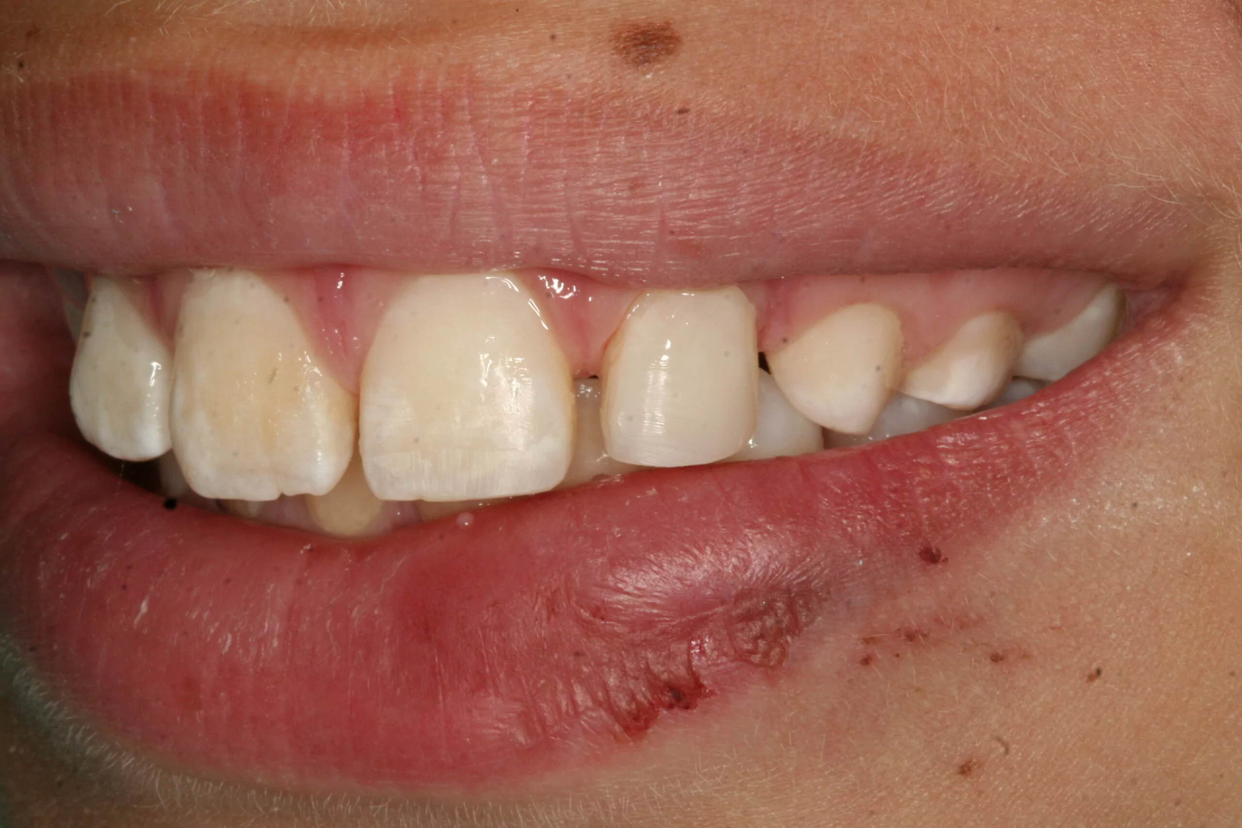 Chipped Tooth Repair and How A Cosmetic Dentist Can Help - Cheadle