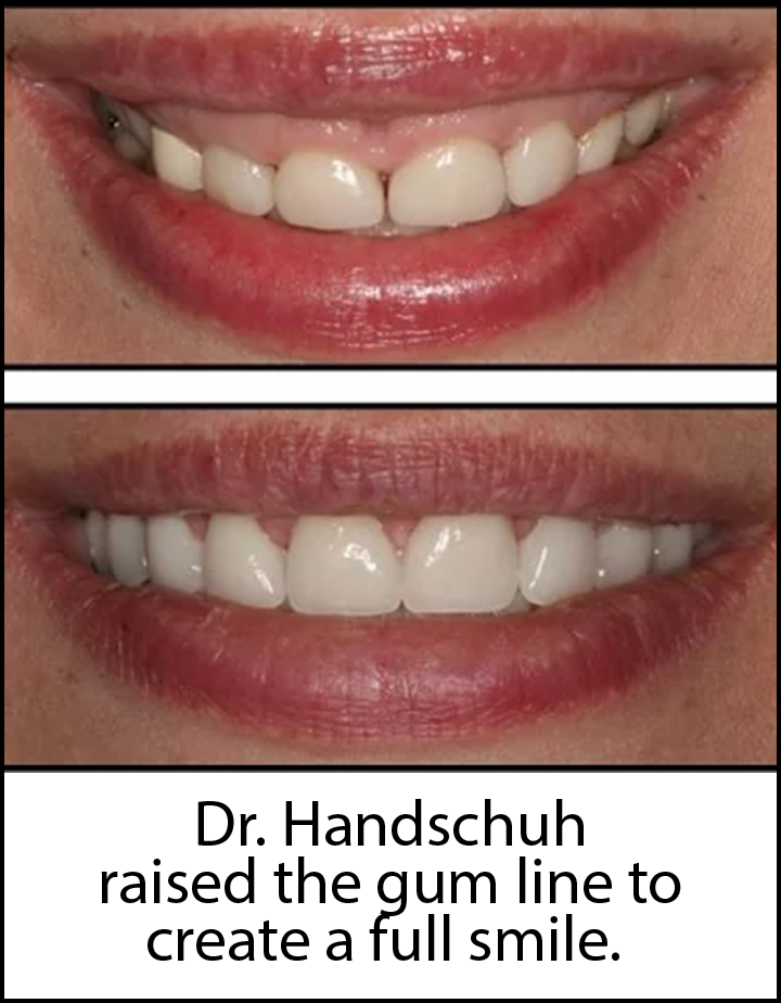 Gum Contouring Patient near Scarsdale