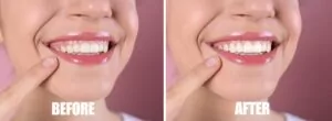 Young woman before and after gum contouring procedure on pink background, closeup