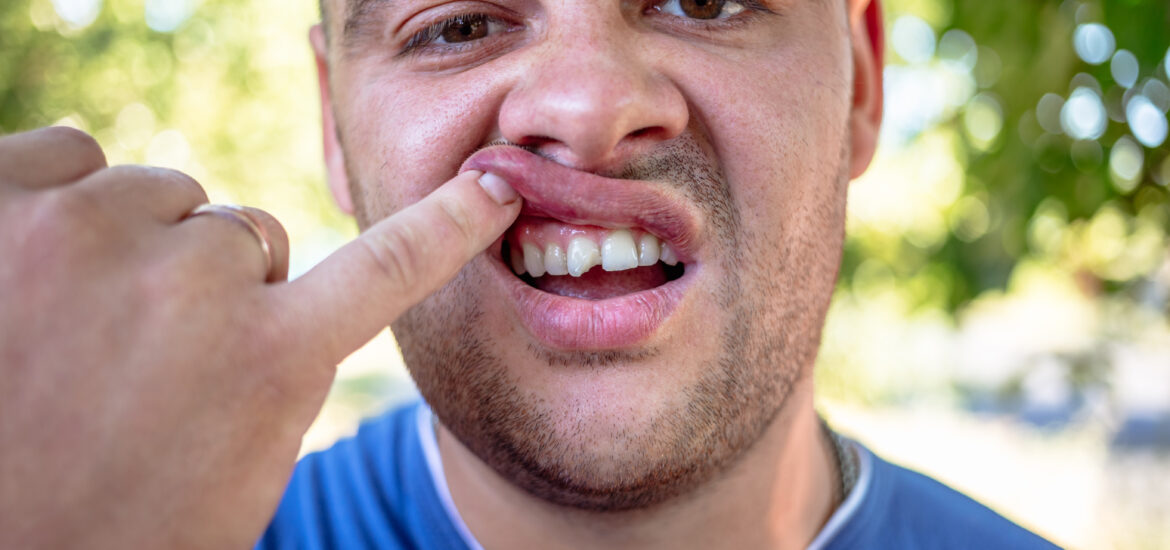 man in a blue shirt showing his chipped tooth