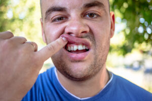 man in a blue shirt showing his chipped tooth