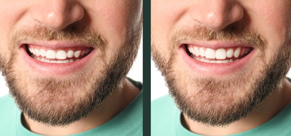 Young man before and after gum contouring procedure, closeup.