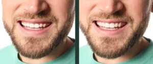 Young man before and after gum contouring procedure, closeup.