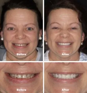 Dental Design Center patient before and after veneers.