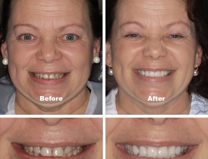 Dental Design Center patient before and after veneers.