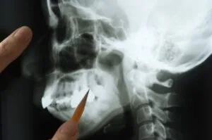 A jawbone X-ray being examined for an emergency dentistry evaluation.