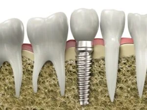 A graphic image of a dental implant placed by a White Plains dentist.